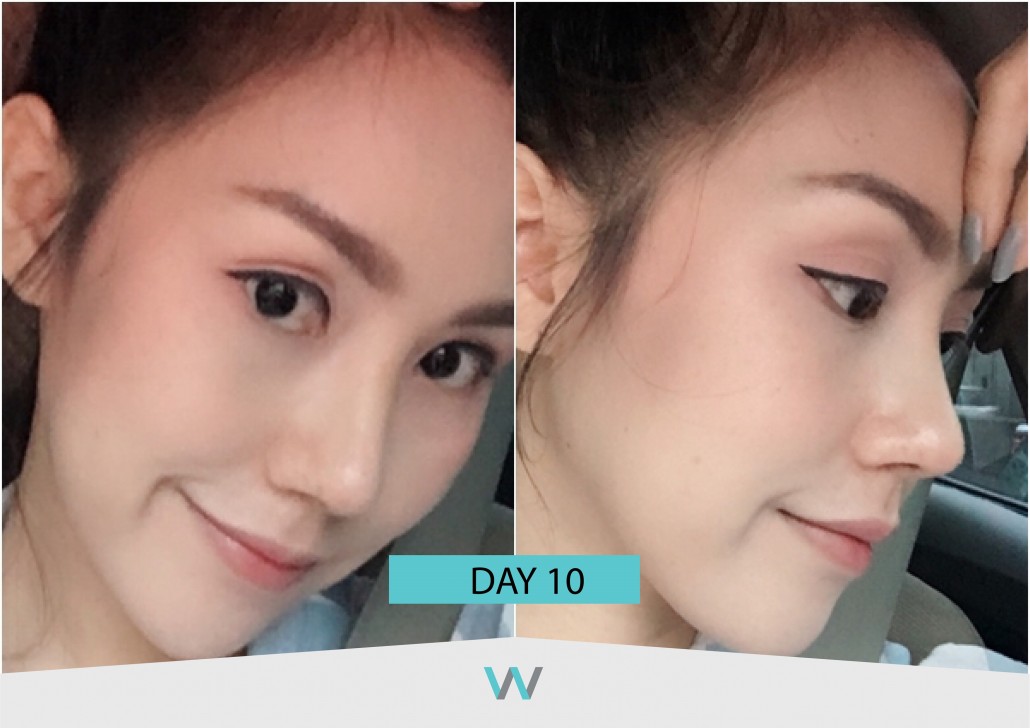 รีวิวจมูก วอนจิน