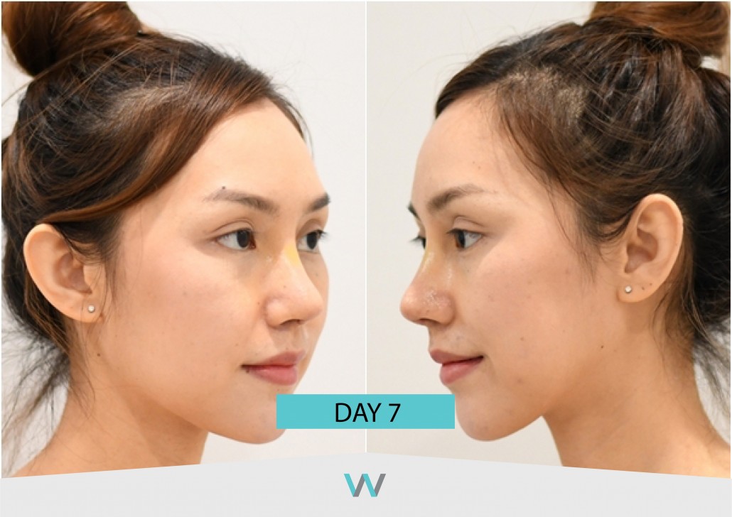 รีวิวจมูก วอนจิน