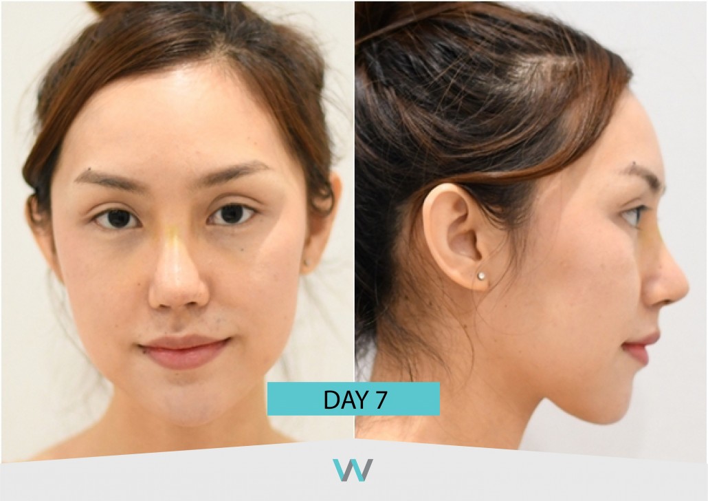 รีวิวจมูก วอนจิน