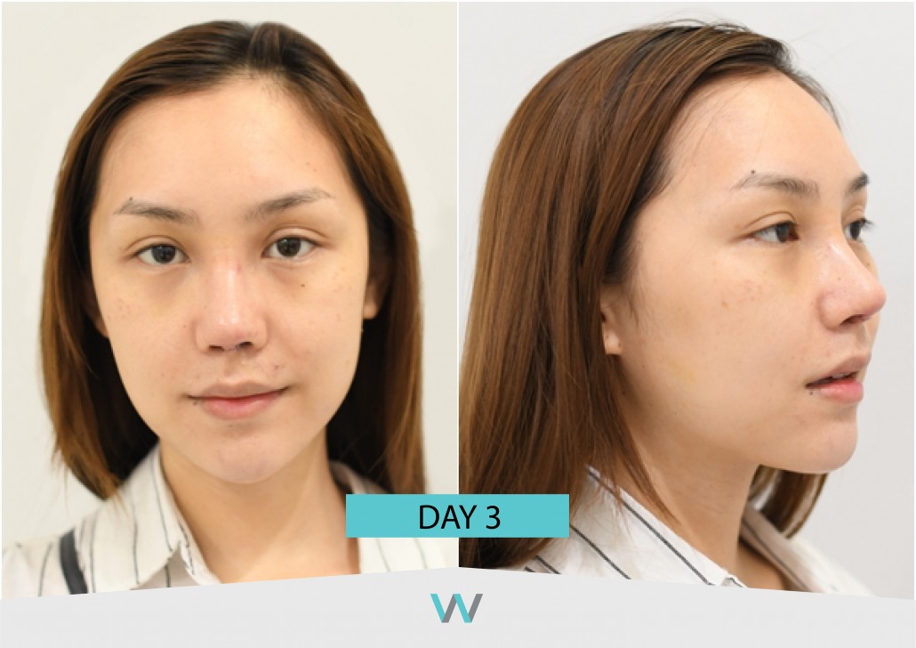 รีวิวจมูก วอนจิน