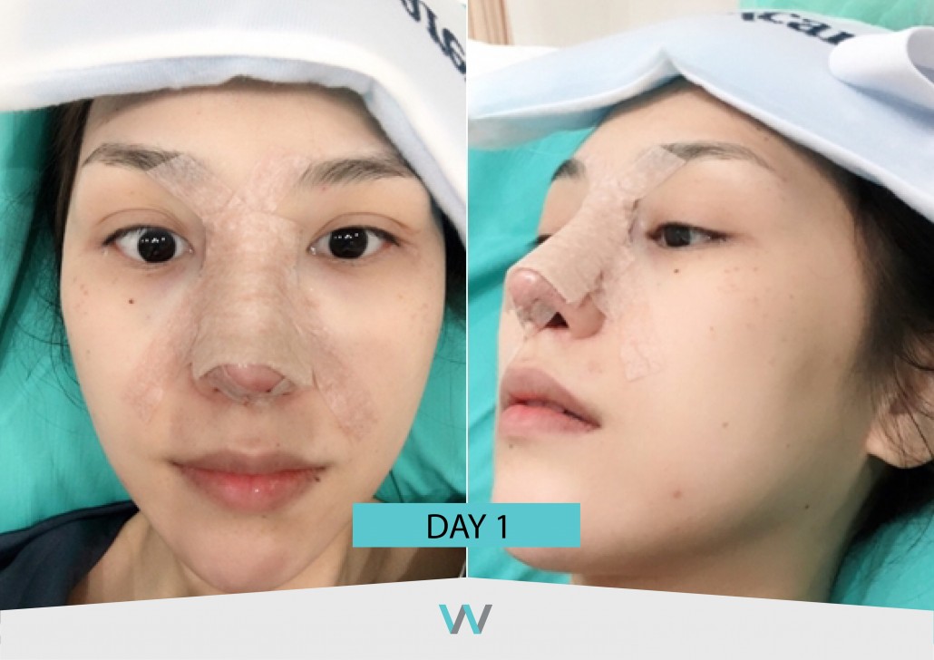 รีวิวจมูก วอนจิน