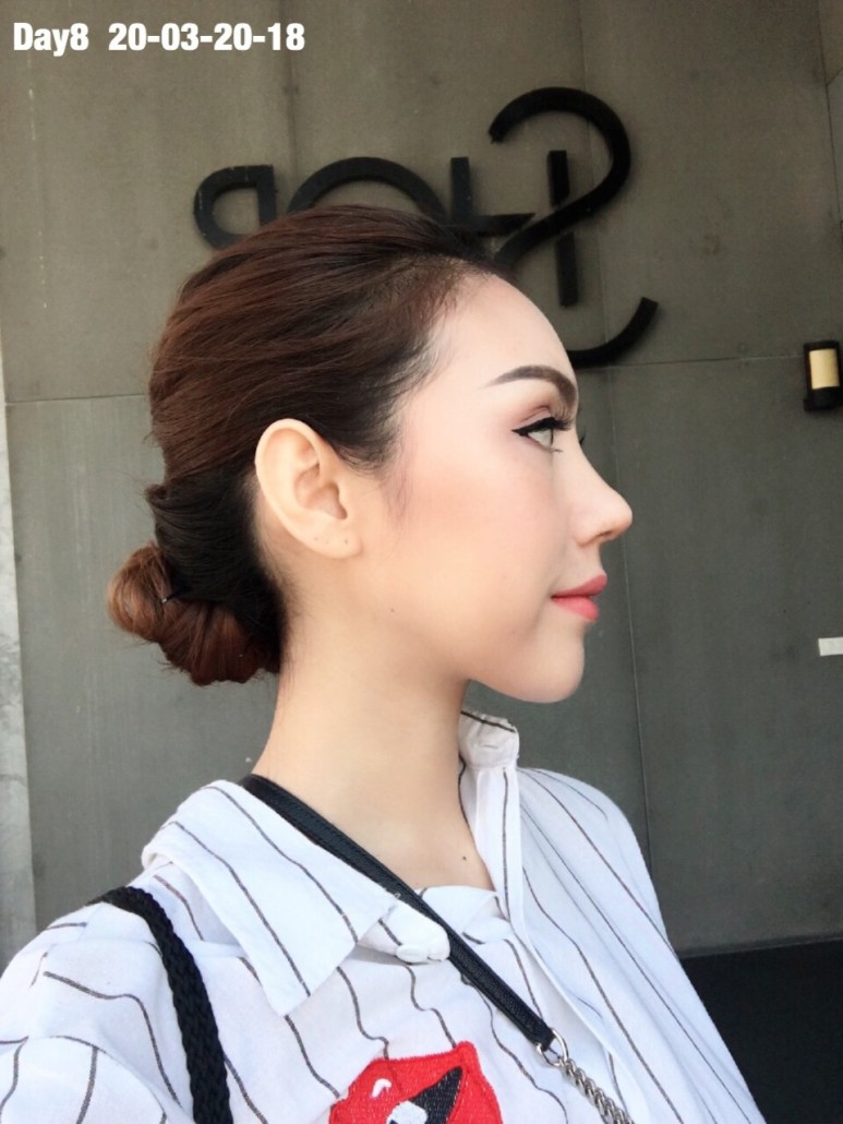 รีวิวจมูก วอนจิน