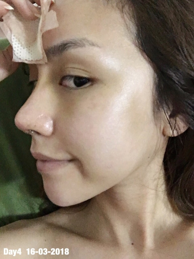 รีวิวจมูก วอนจิน