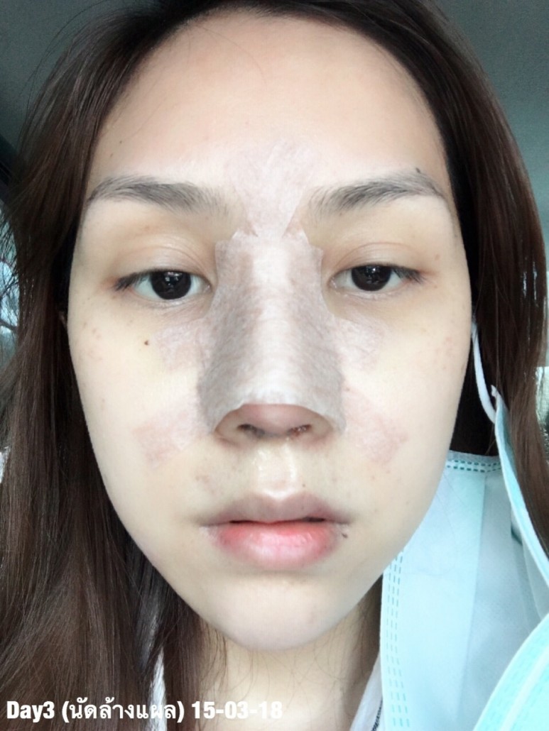 รีวิวจมูก วอนจิน