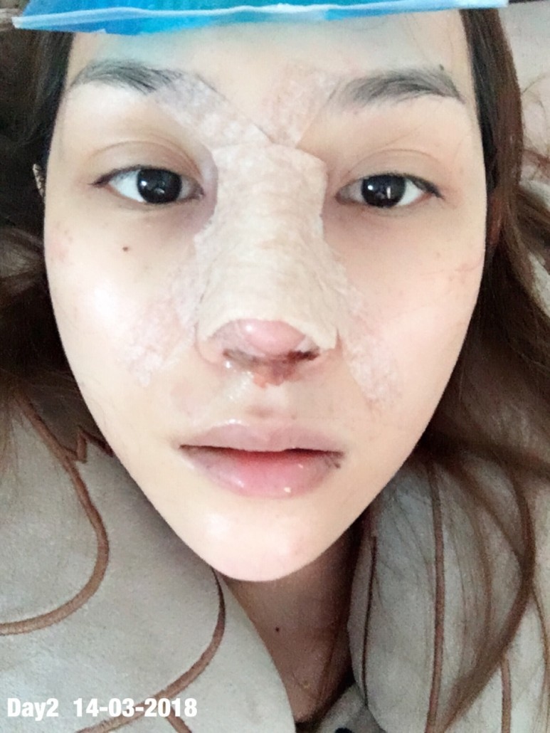 รีวิวจมูก วอนจิน